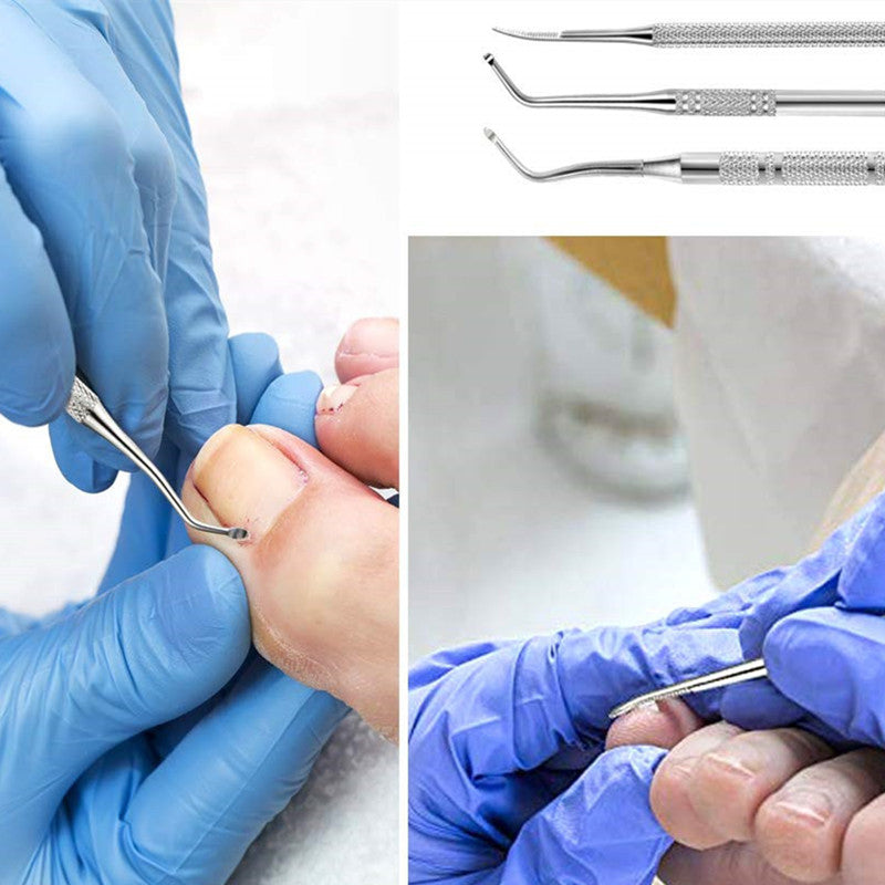 3 petits  outil d’ongles d’orteils incarnés en acier inoxydable, lime à ongles et lève-ongles, traitement des ongles chirurgical sûr Kit d’outils de pédicure Outils de nettoyage des ongles soulagement de la douleur